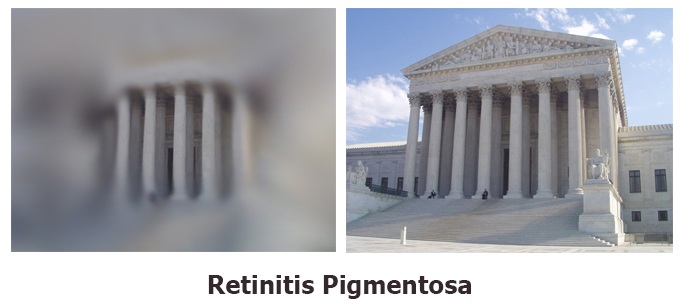 Retinitis-Pigmentosa