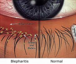 blepharitis pictoral