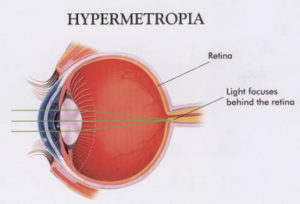 a hyperopia élesen kialakult látás 7 rövidlátás